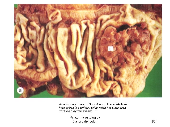 An adenocarcinoma of the colon - L. This is likely to have arisen in