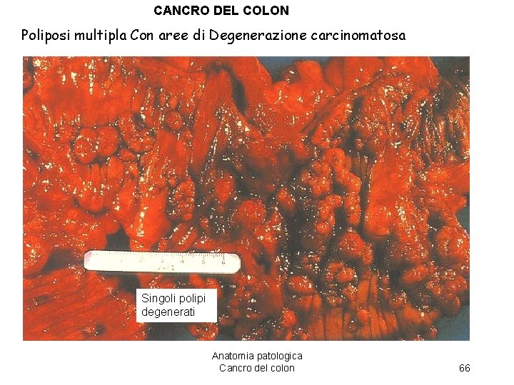 CANCRO DEL COLON Poliposi multipla Con aree di Degenerazione carcinomatosa Singoli polipi degenerati Anatomia