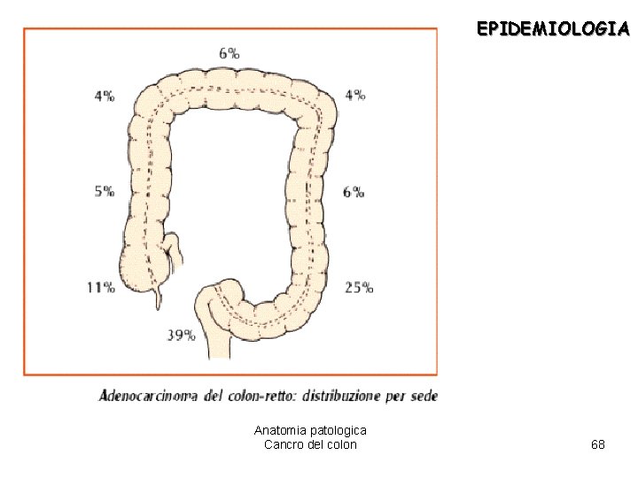 EPIDEMIOLOGIA Anatomia patologica Cancro del colon 68 