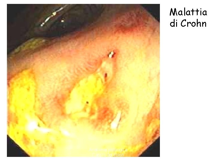 Malattia di Crohn Anatomia patologica Cancro del colon 7 
