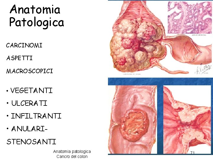 Anatomia Patologica CARCINOMI ASPETTI MACROSCOPICI • VEGETANTI • ULCERATI • INFILTRANTI • ANULARISTENOSANTI Anatomia