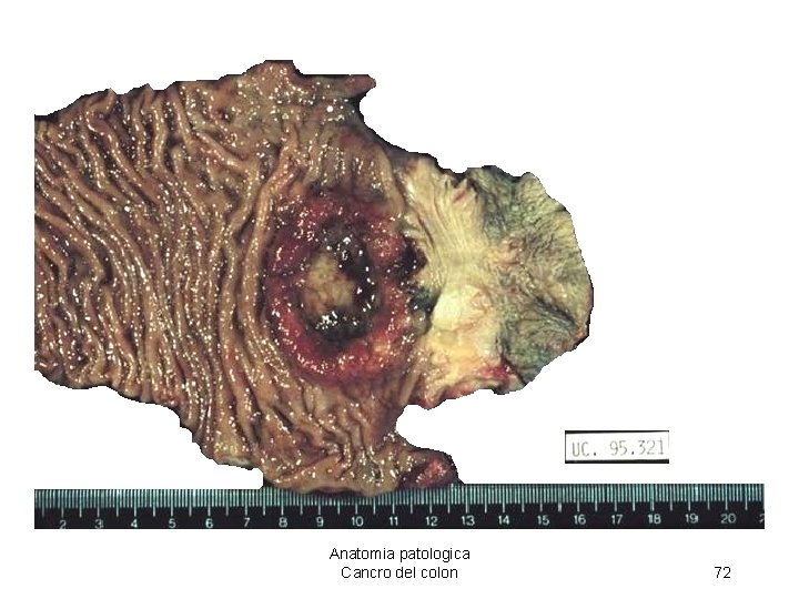 Anatomia patologica Cancro del colon 72 