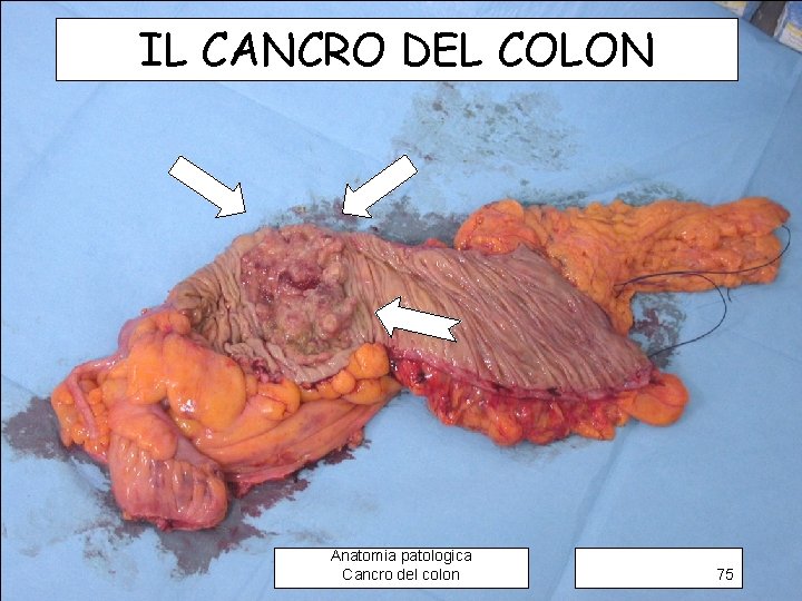 IL CANCRO DEL COLON Anatomia patologica Cancro del colon 75 