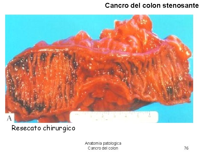 Cancro del colon stenosante Resecato chirurgico Anatomia patologica Cancro del colon 76 