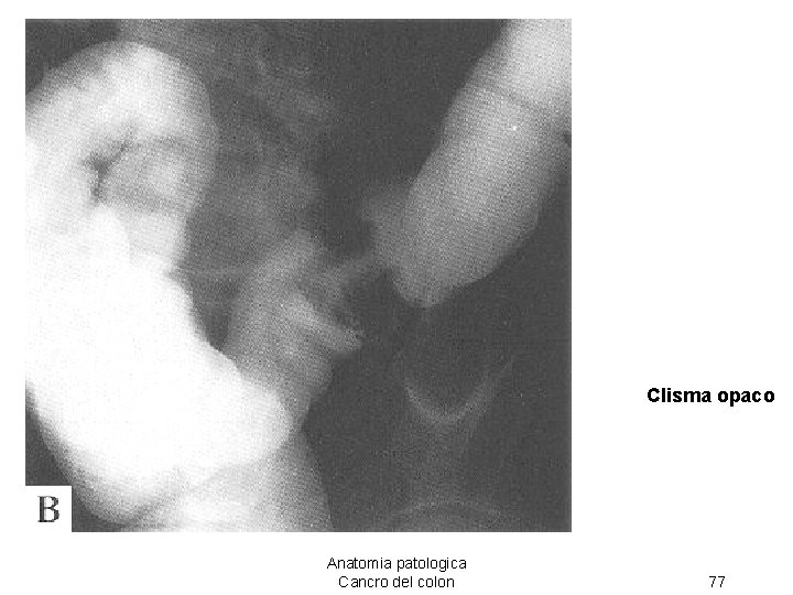 Clisma opaco Anatomia patologica Cancro del colon 77 
