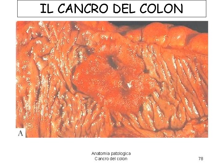 IL CANCRO DEL COLON Anatomia patologica Cancro del colon 78 