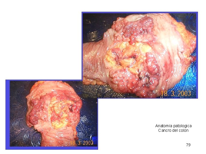 Anatomia patologica Cancro del colon 79 