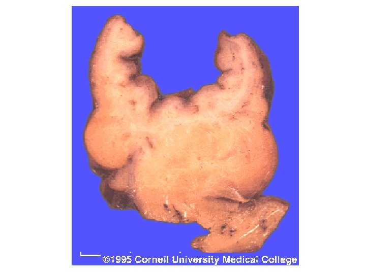 Anatomia patologica Cancro del colon 8 