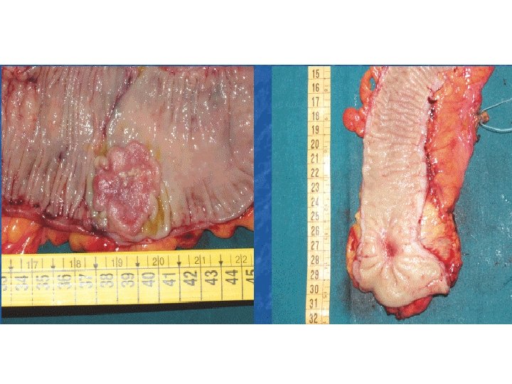 Anatomia patologica Cancro del colon 80 