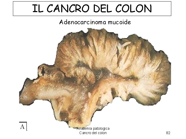 IL CANCRO DEL COLON IL CANCRO COLON Adenocarcinoma mucoide Anatomia patologica Cancro del colon