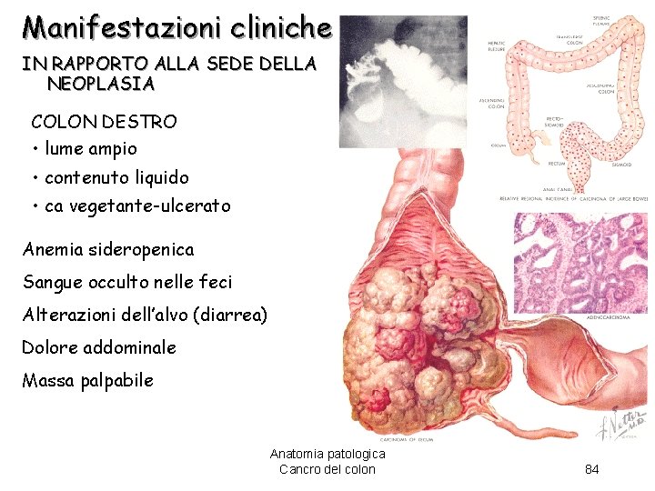 Manifestazioni cliniche IN RAPPORTO ALLA SEDE DELLA NEOPLASIA COLON DESTRO • lume ampio •