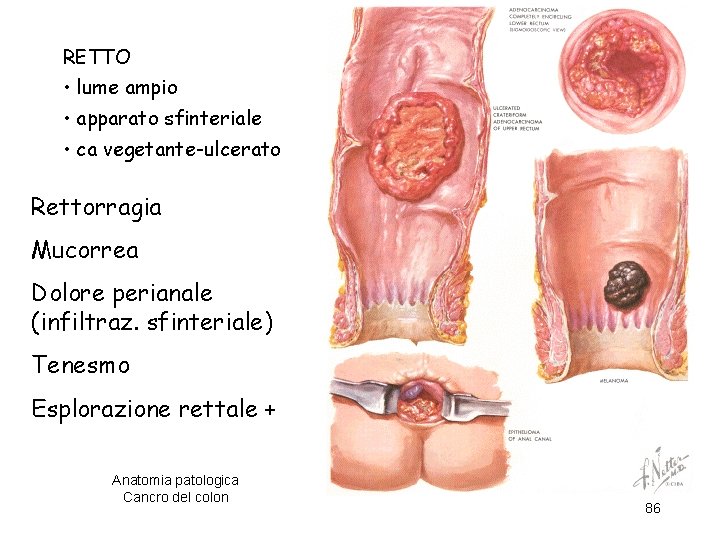 RETTO • lume ampio • apparato sfinteriale • ca vegetante-ulcerato Rettorragia Mucorrea Dolore perianale