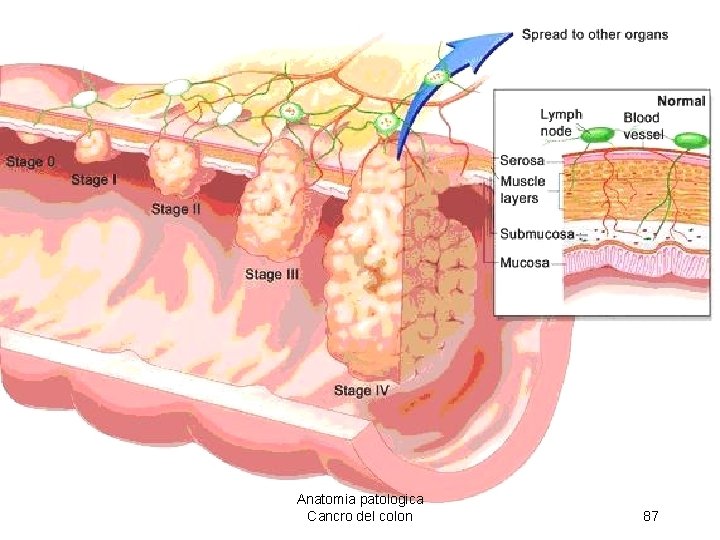 Anatomia patologica Cancro del colon 87 