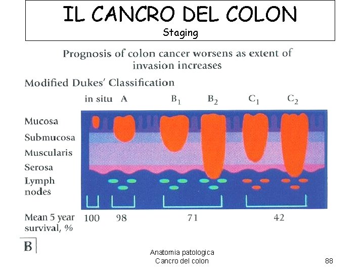 IL CANCRO DEL COLON Staging Anatomia patologica Cancro del colon 88 