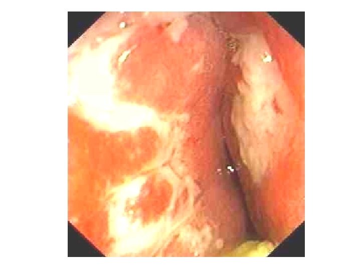 Anatomia patologica Cancro del colon 9 