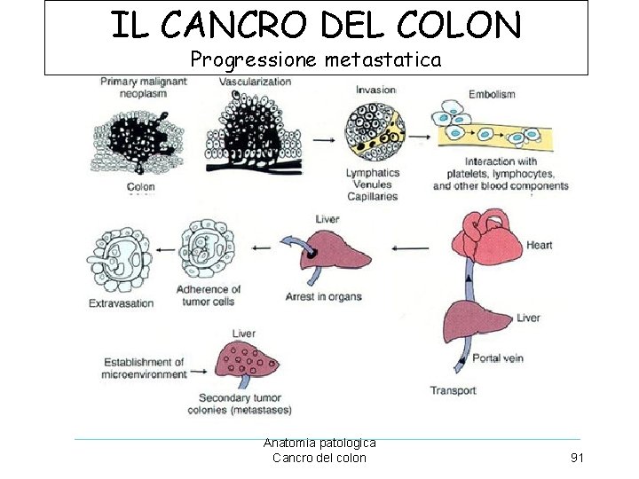 IL CANCRO DEL COLON Progressione metastatica Anatomia patologica Cancro del colon 91 