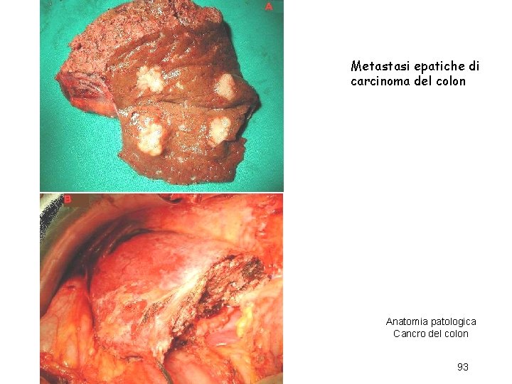 Metastasi epatiche di carcinoma del colon Anatomia patologica Cancro del colon 93 