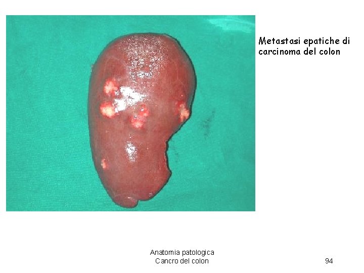 Metastasi epatiche di carcinoma del colon Anatomia patologica Cancro del colon 94 