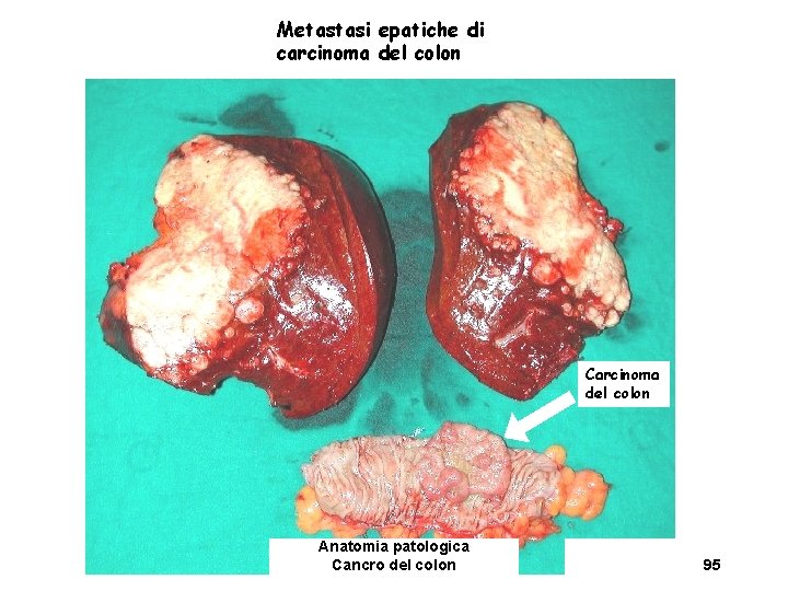 Metastasi epatiche di carcinoma del colon Carcinoma del colon Anatomia patologica Cancro del colon