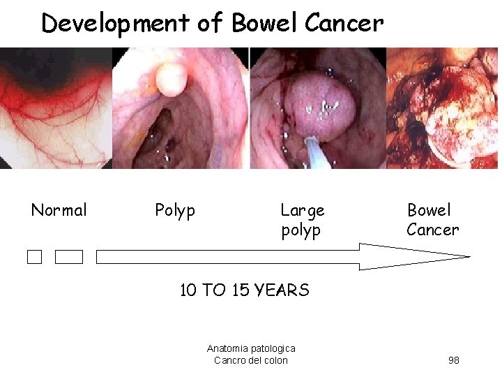 Development of Bowel Cancer Normal Polyp Large polyp Bowel Cancer 10 TO 15 YEARS