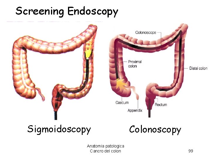Screening Endoscopy Sigmoidoscopy Anatomia patologica Cancro del colon Colonoscopy 99 
