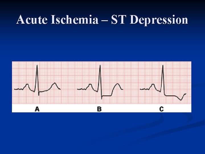 Acute Ischemia – ST Depression 