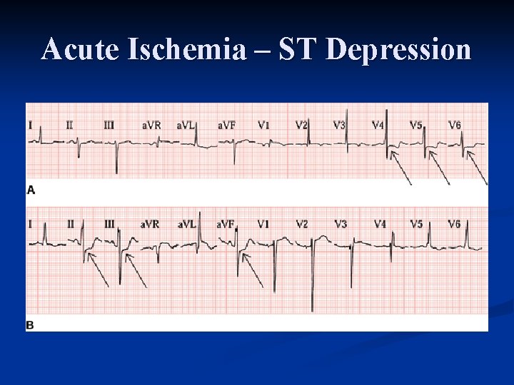 Acute Ischemia – ST Depression 