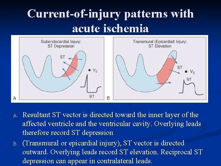 Current-of-injury patterns with acute ischemia A. B. Resultant ST vector is directed toward the