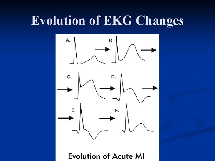 Evolution of EKG Changes 