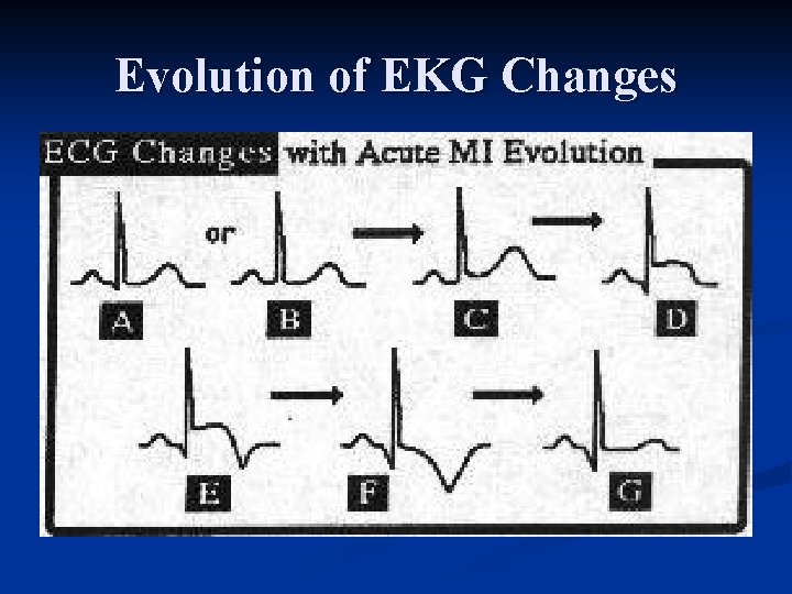 Evolution of EKG Changes 