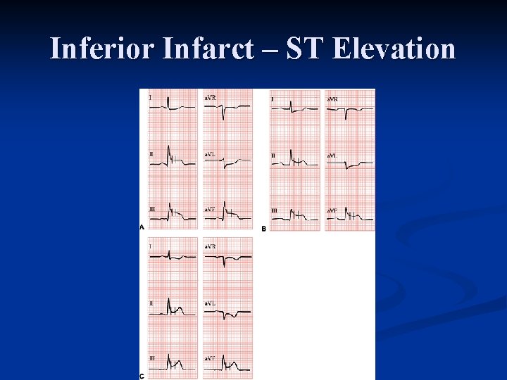 Inferior Infarct – ST Elevation 