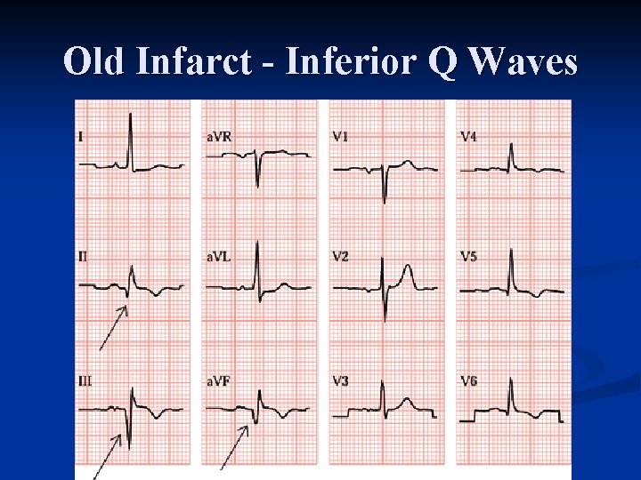 Old Infarct - Inferior Q Waves 