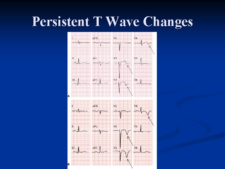 Persistent T Wave Changes 