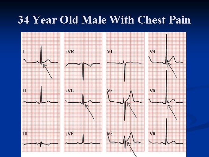 34 Year Old Male With Chest Pain 