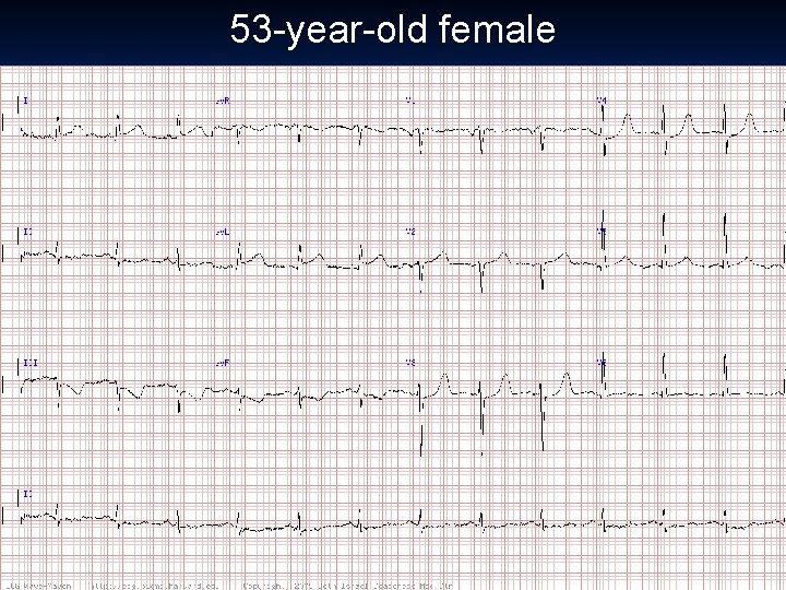 53 -year-old female 