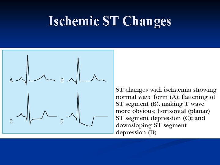 Ischemic ST Changes 