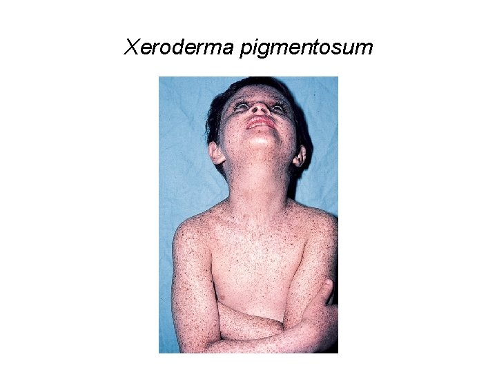 Xeroderma pigmentosum 