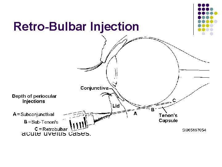Retro-Bulbar Injection l l l Subconjunctival injections Injections may be administered under the conjunctiva