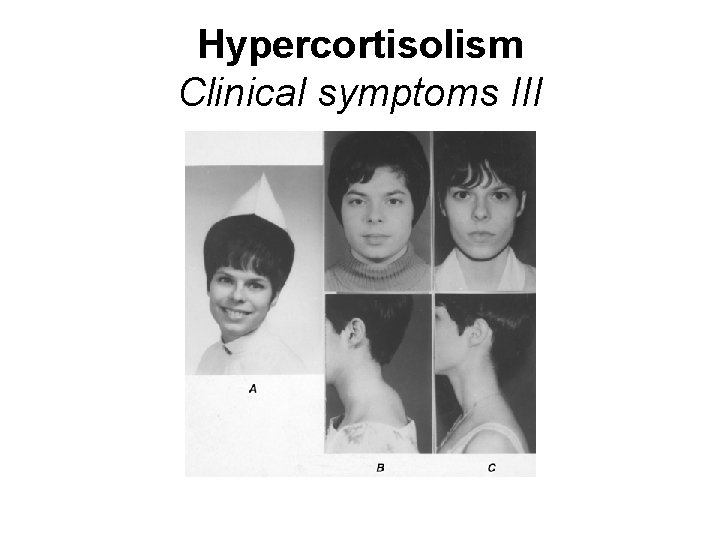 Hypercortisolism Clinical symptoms III 