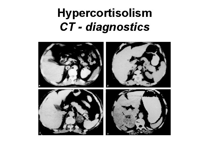 Hypercortisolism CT - diagnostics 