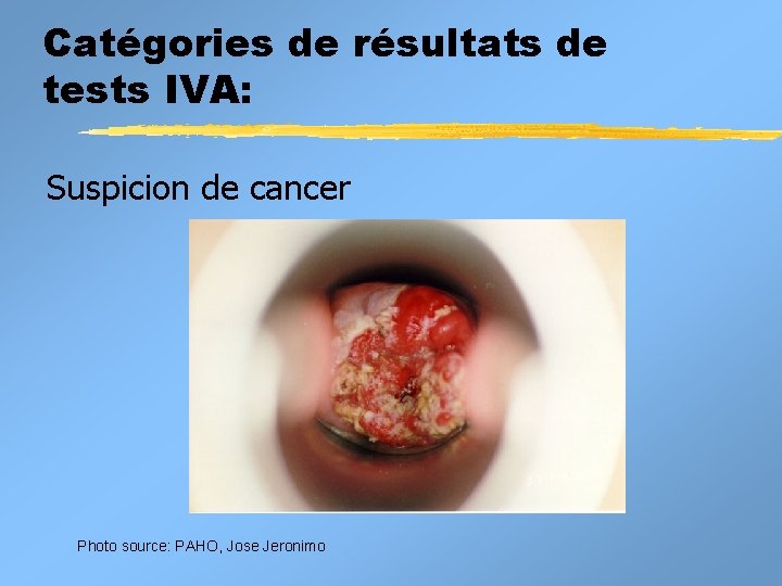 Catégories de résultats de tests IVA: Suspicion de cancer Photo source: PAHO, Jose Jeronimo