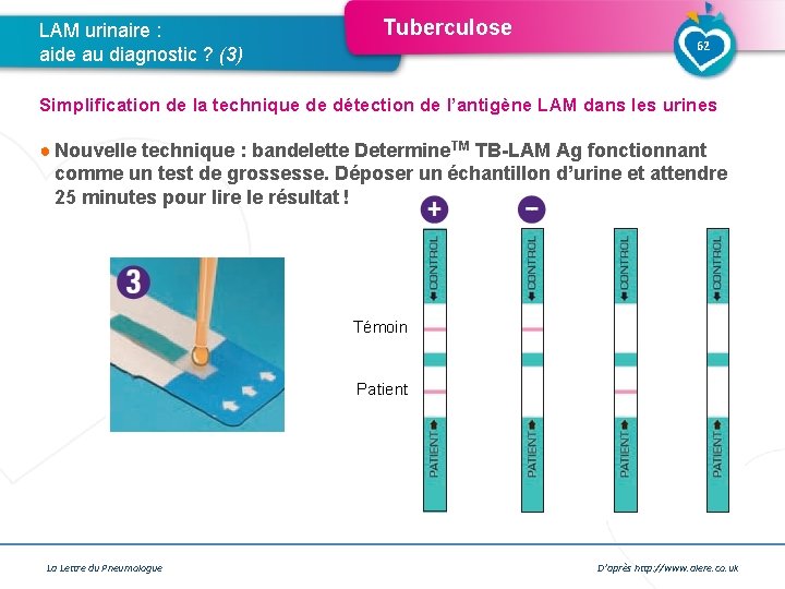 LAM urinaire : aide au diagnostic ? (3) Tuberculose 62 Simplification de la technique