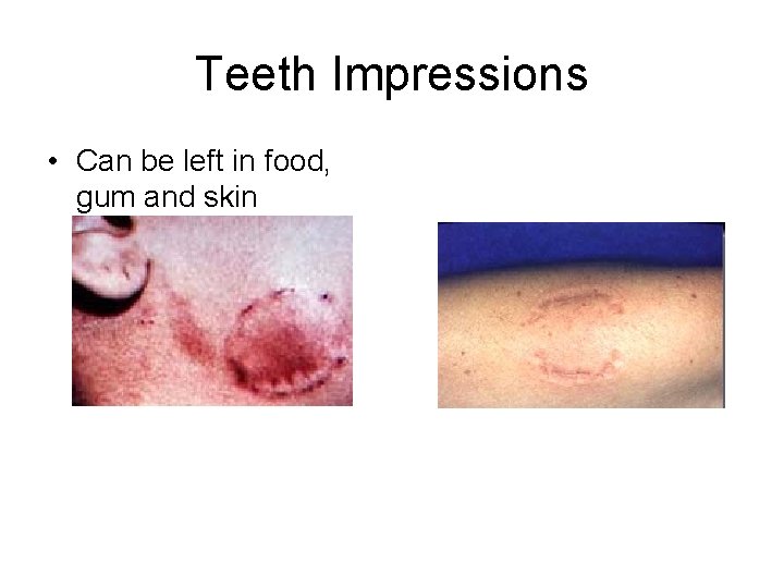 Teeth Impressions • Can be left in food, gum and skin 