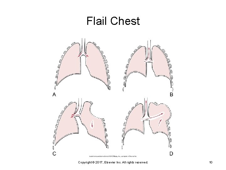 Flail Chest Copyright © 2017, Elsevier Inc. All rights reserved. 10 