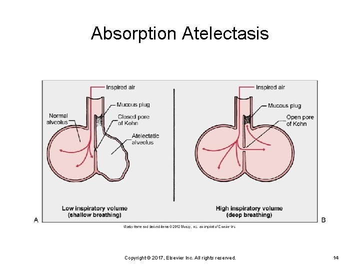 Absorption Atelectasis Copyright © 2017, Elsevier Inc. All rights reserved. 14 