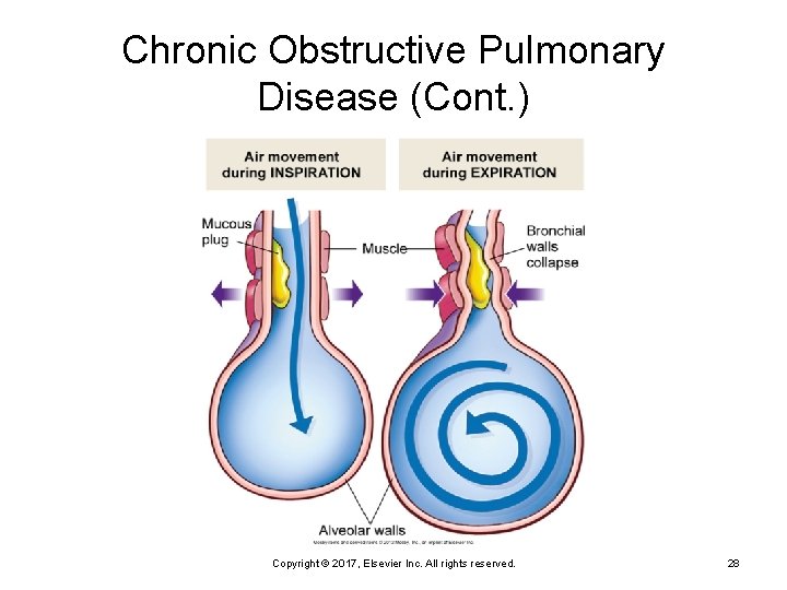 Chronic Obstructive Pulmonary Disease (Cont. ) Copyright © 2017, Elsevier Inc. All rights reserved.