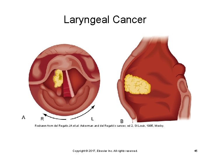 Laryngeal Cancer Redrawn from del Regato JA et al: Ackerman and del Regato’s cancer,