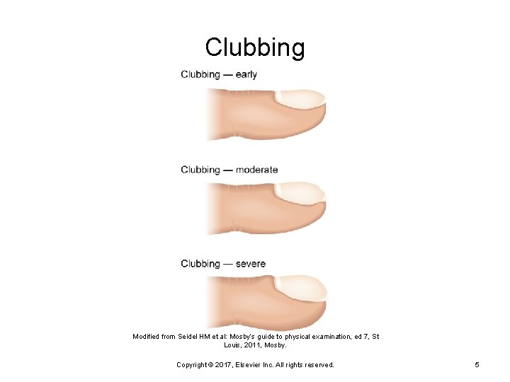 Clubbing Modified from Seidel HM et al: Mosby’s guide to physical examination, ed 7,