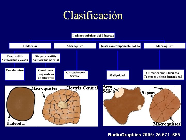 Clasificación Microquistes Unilocular Cicatriz Central Área Sólida Septos Macroquistes Radio. Graphics 2005; 25: 671–