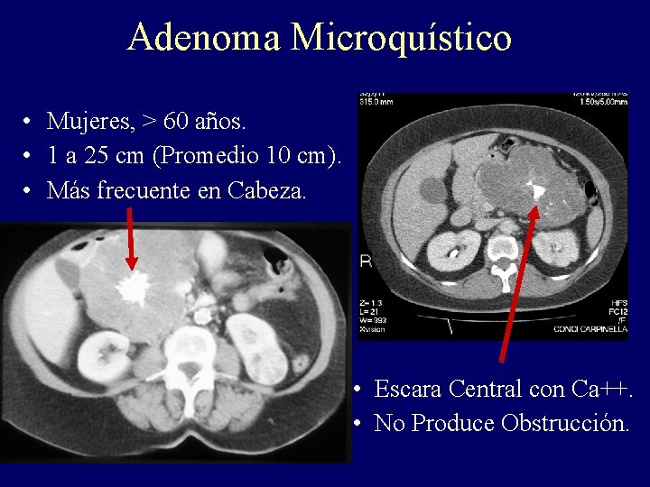 Adenoma Microquístico • Mujeres, > 60 años. • 1 a 25 cm (Promedio 10